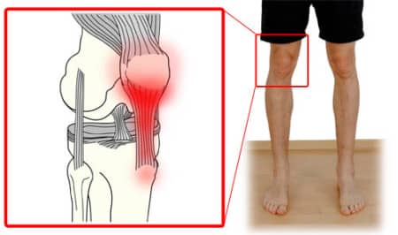 patellar-tendonitis-pain