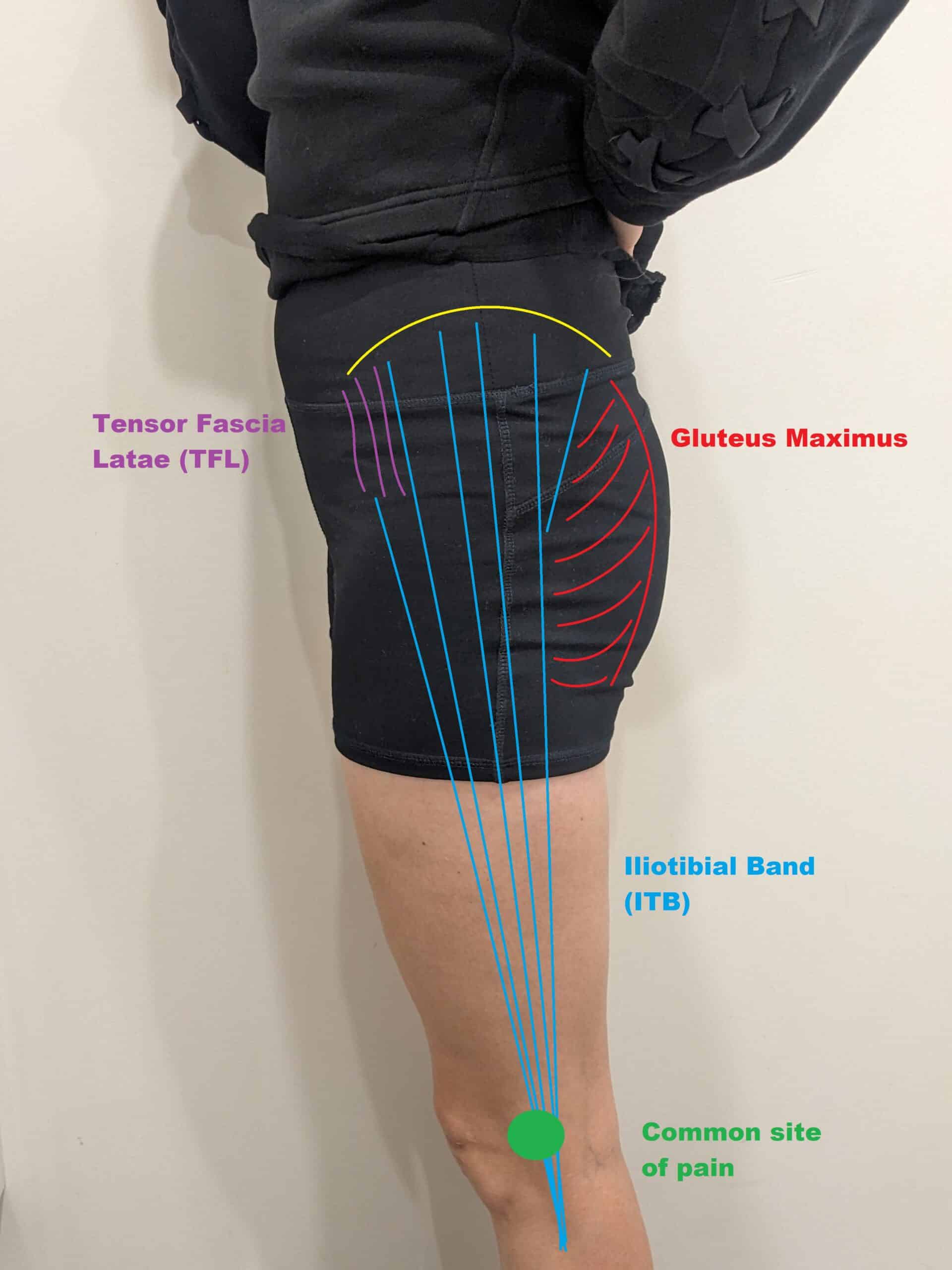 Iliotibial Band Friction Syndrome (ITBFS)